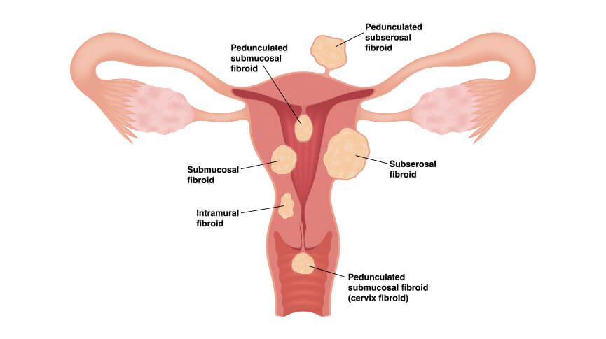 Can Uterine Fibroids Cause Bladder Problems?