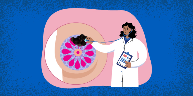 Self-Exam: What Does a Breast Cancer Lump Feel Like?